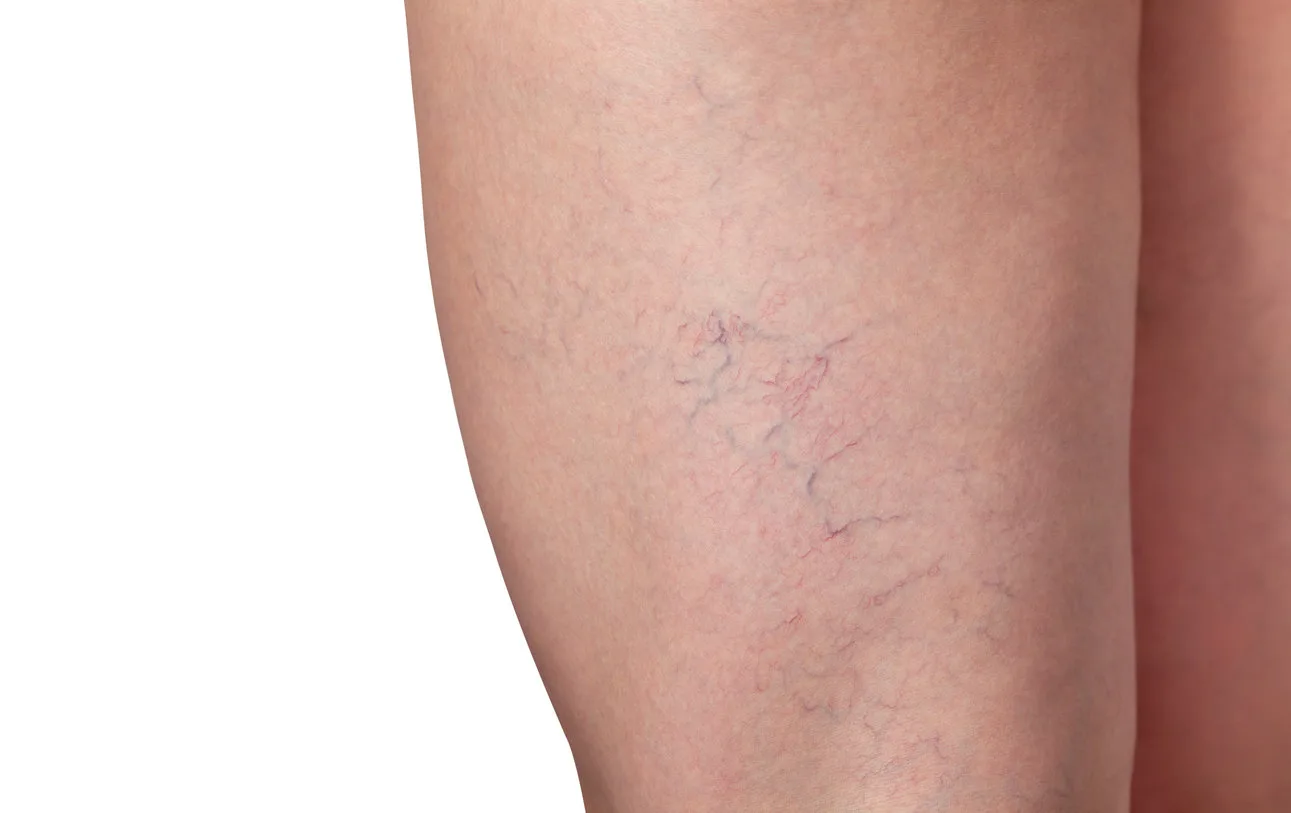 Spider Veins