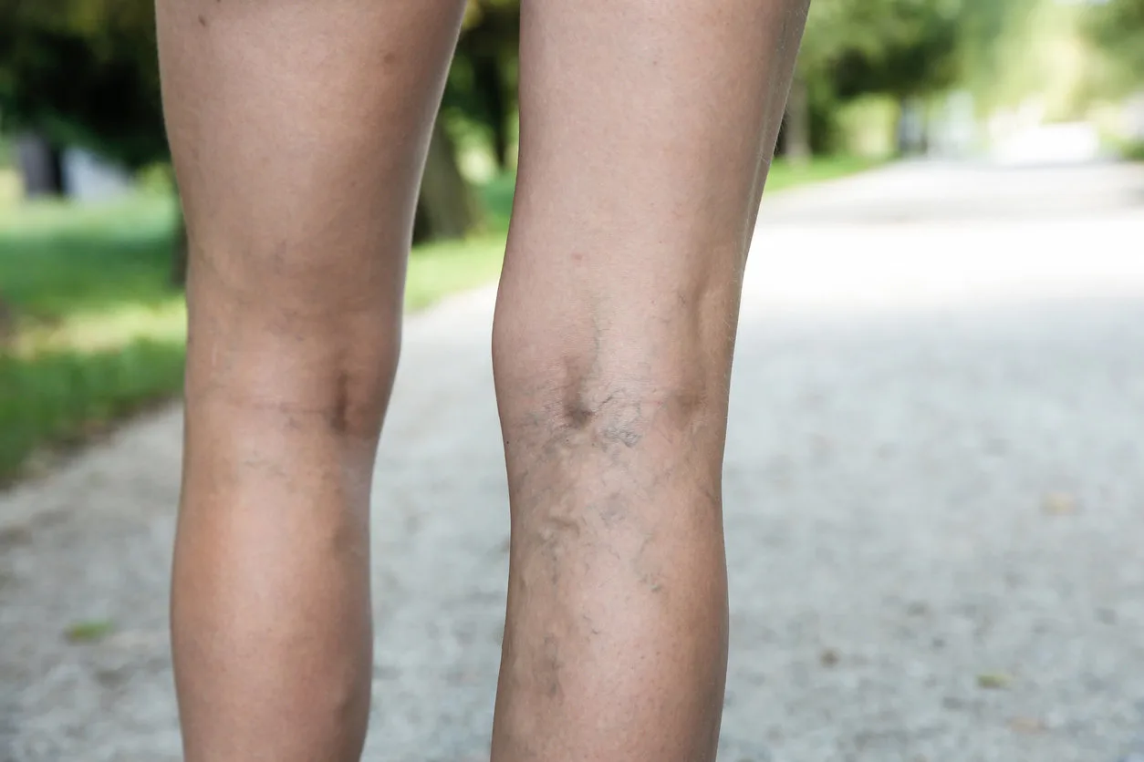 Varicose Veins